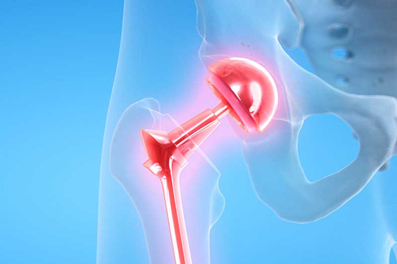 ORTHOPEDICS-JOINT-REPLACEMENT