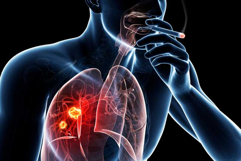 RESPIRATORY DISEASES